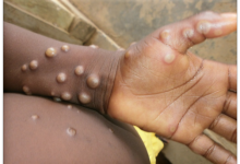 Photo of African states report 1,400 monkeypox cases – WHO