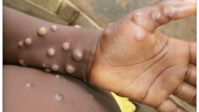 Photo of E/R: Afram Plains, Birim North record three suspected cases of Monkeypox